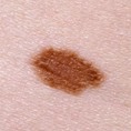 An atypical mole
