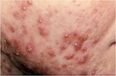 Nilesh Morar_ Acne image Nilesh Morar_ Acne image