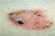 Nilesh Morar_Skin Cancer image